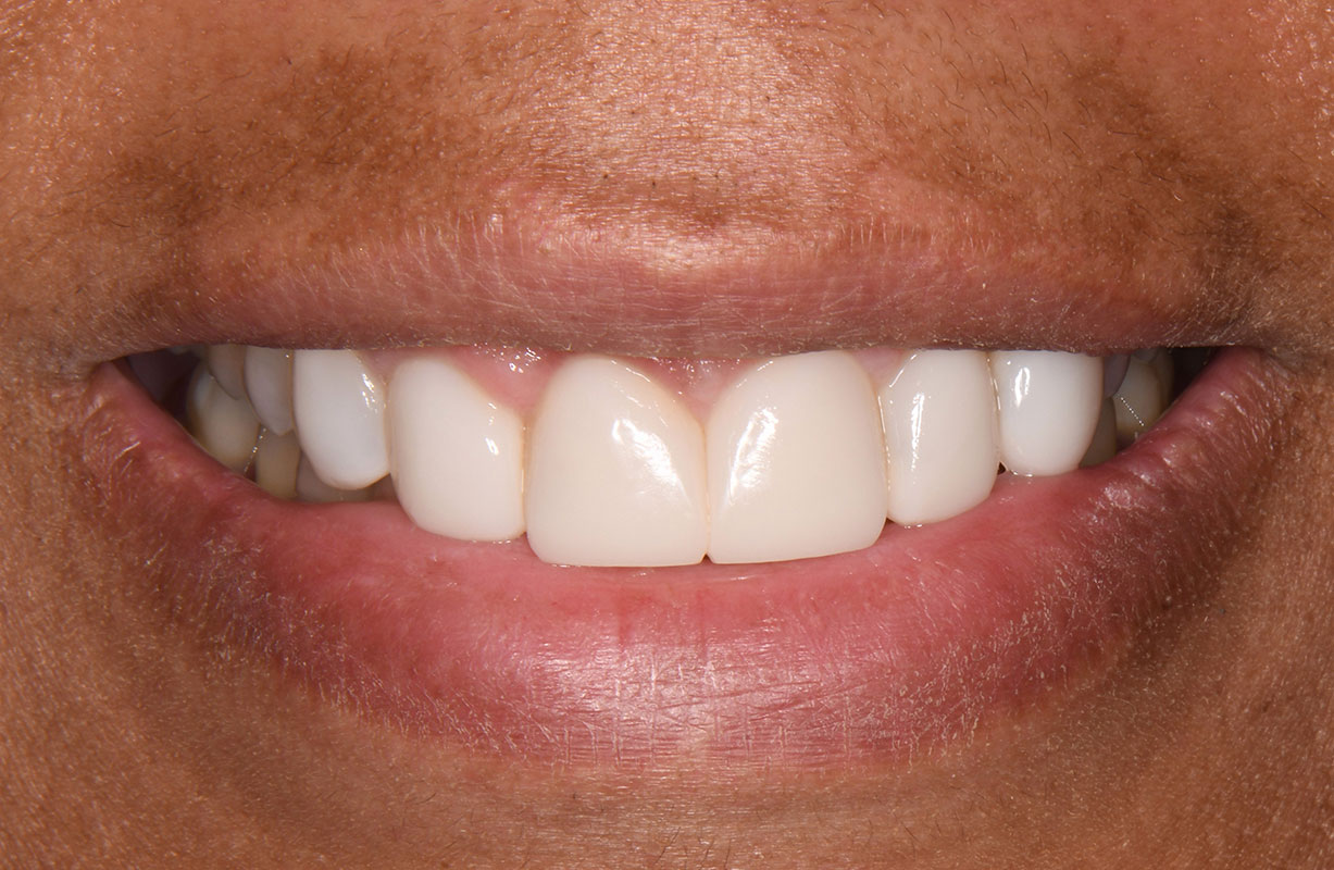 Bioclear Diastema Closure » Bioclear Clinic