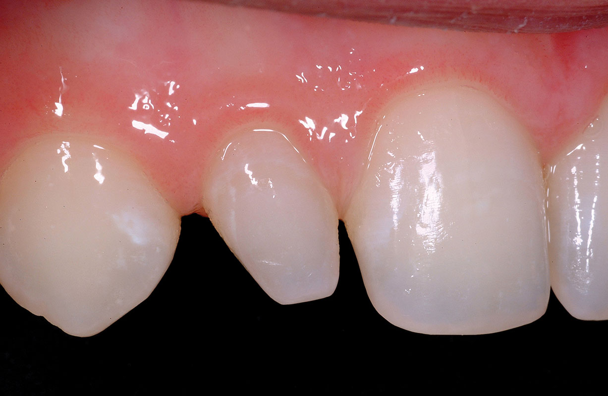 Space closure and undersized teeth – Bioclear Clinic