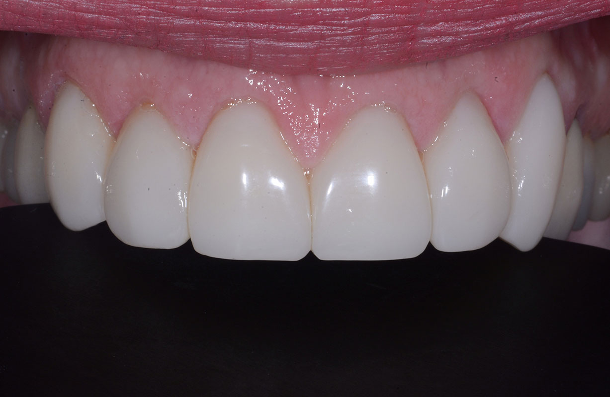 Bioclear 360° Veneers - Bioclear Clinic