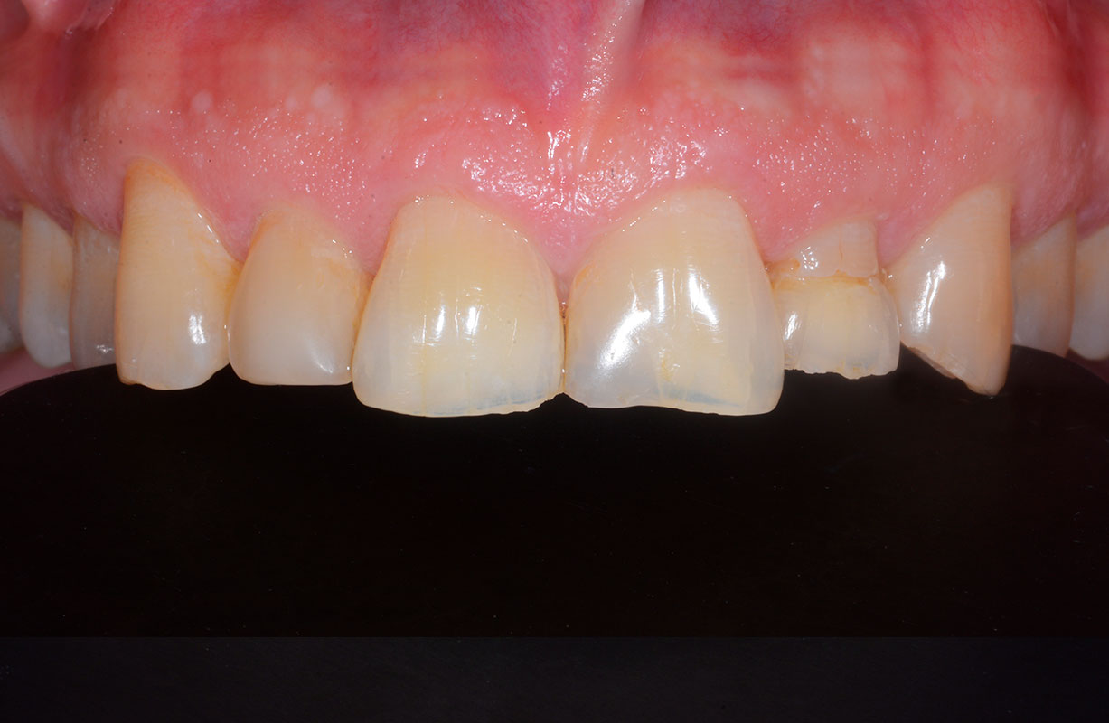 Bioclear 360° Veneers - Bioclear Clinic