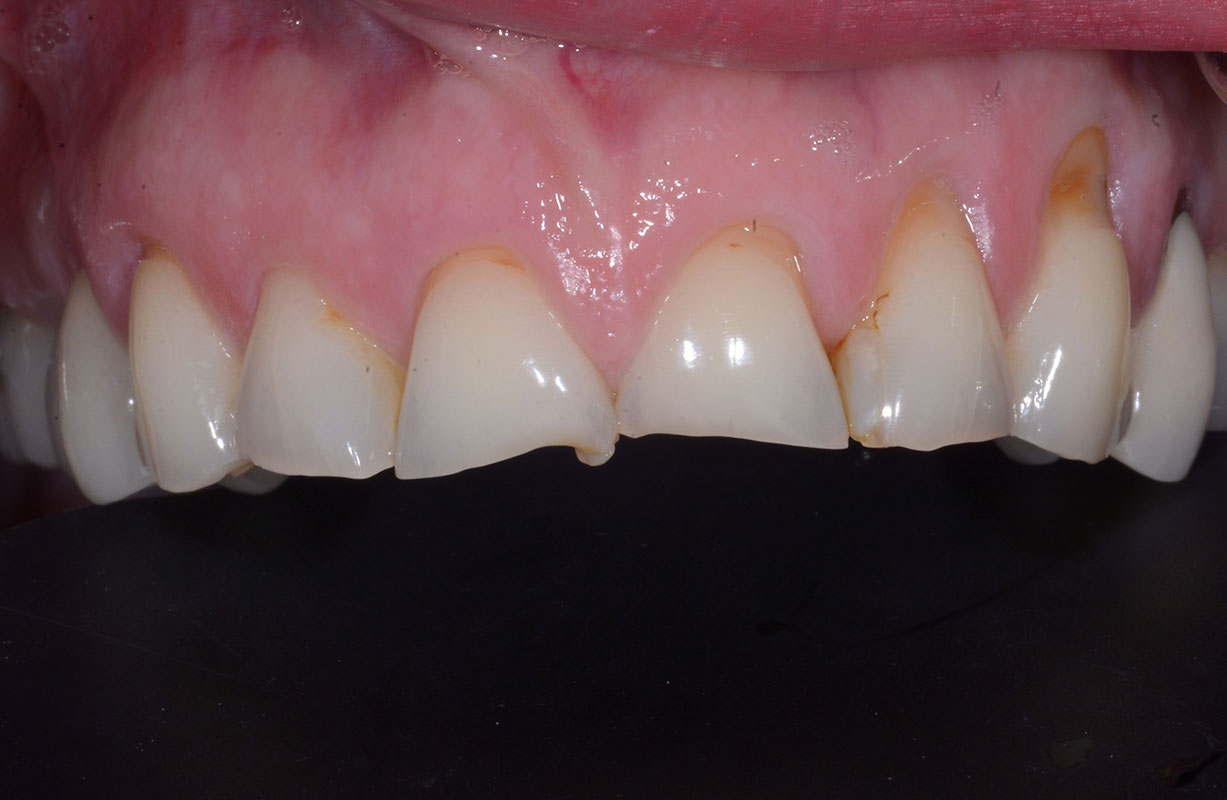 Worn or Broken Teeth - Bioclear Clinic