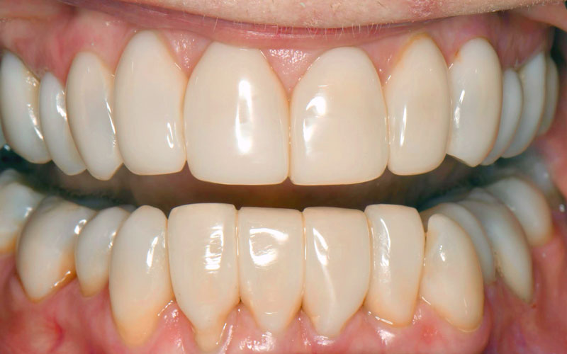 Black triangles closure Bioclear Clinic